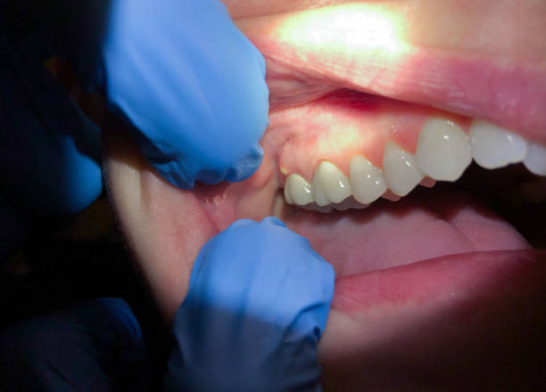 Best Emergency Root Canal Treatment in Montrose, PA