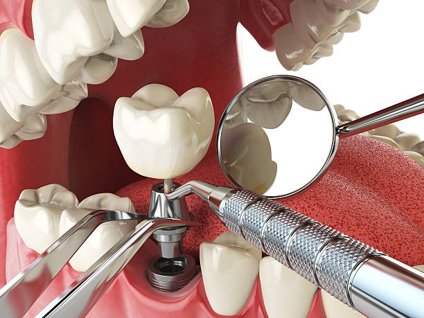 Best Broken or Cracked Tooth Emergency Dentist in Montrose, PA